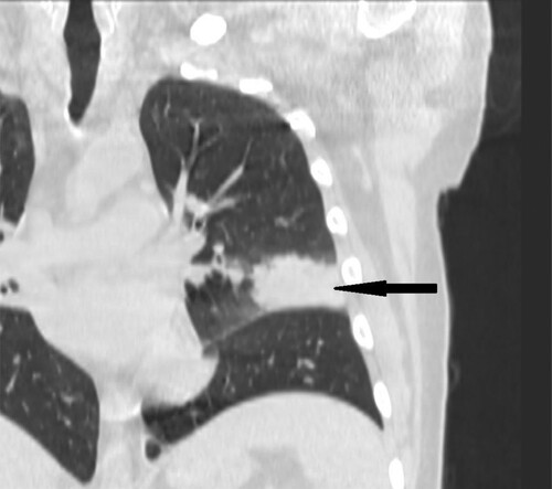 Figure 8. 35-year-old male with acute myeloid leukemia presenting with dry cough. High resolution CT in coronal plane shows wedge-shape consolidations located in lingular segment in left lung (black narrow arrow).