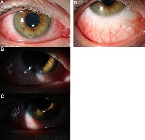 Figure 3 (A–C) Slit lamp photographs demonstrate diffuse conjunctival injection and 2 inferior marginal stromal infiltrates, at 6 o’clock and 8 o’clock. (D) After 1 week of treatment with topical fluorometholone 0.1% there is resolution of marginal stromal infiltrates.