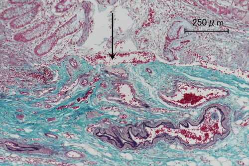 Figure 3. Photomicrograph of case 3. Elastica-Masson staining demonstrates ruptured arteriole (arrow), clarifying the cause of severe hemorrhage.