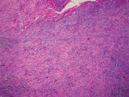 FIGURE 6  Histopathological specimen suggestive of chronic inflammation.