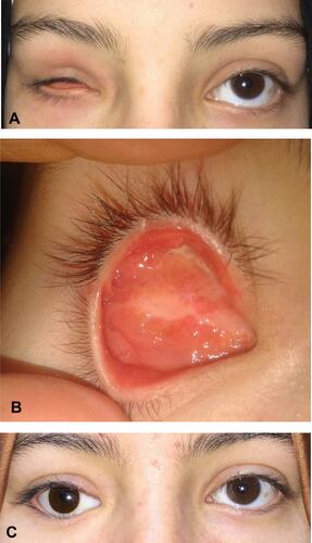 Figure 2 (A) Preoperative photo of a patient with congenital microphthalmia. (B) Postoperative appearance with complete healing and mild discharge 8 week after surgery (Scalpel dissection). (C) After prosthesis fitting with adequate cosmesis despite of lower lid mild entropion.