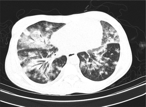 Figure 1. CT scan showing diffuse airspace Consolidations.