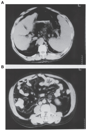 Figure 1 Abdominal echosonography (A) and computed tomography (B) show severe edema of mesenterium and the absence of free ascitic fluid, atrophic cirrhotic liver, and splenomegaly.