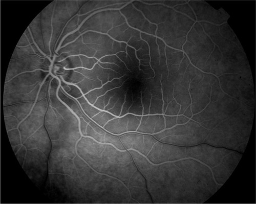 Figure 2 Fluorescein angiography images revealed only a vertical choroidal watershed centered on the optic disk, a faint screen effect in the perifoveal area due to intraretinal edema, and a normal CRA perfusion.