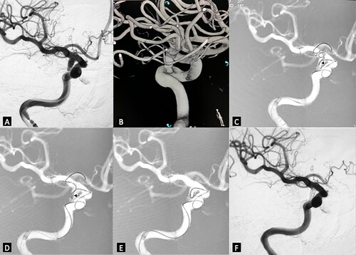 Figure 2. Right posterior communicating aneurysm was embolized with the novel coil guiding catheterization technique. (A) working projection revealed an irregular shaped aneurysm located in the posterior communicating artery segment. (B) 3D reconstruction demonstrated very tortuous vessel access. (C) the microcatheter tip was advanced near the aneurysm neck (small black arrow). The coil was inserted. Coil loops were protruded to the distal ICA and A1, some were in the aneurysm sac. (D) the microcatheter was advanced while the coil was slightly retrieved until the microcatheter tip was totally in the aneurysm sac. (E) the coil outside the aneurysm sac was retrieved before the true framing process started. (F) final control after the coiling demonstrated no contrast filling of the aneurysm sac.