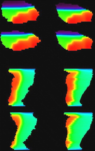 Figure 4.  Dose images in the sagittal plane for the bladder (top four) and rectum (bottom four). To the left are to dose distributions generated in organs delineated in cone beam CT images, while to the right are corresponding warped dose distributions in the reference organ.