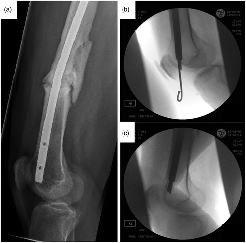Figure 1. Radiographs of the first broken-nail removal by a modification of the technique of Magu et al. Citation[2]. (a) Lateral view of the femoral pseudarthrosis with the broken nail. (b) Intraoperative fluoroscopic image showing an antegrade inserted guide-wire, which was bent outside the knee after distal perforation. (c) Retraction of the bent guide-wire removes the distal part of the broken nail.