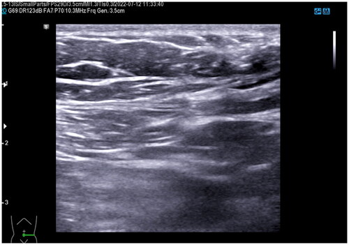 Figure 8. B-Ultrasound for patient in 2nd year after HIFU (Jun. 12nd, 2022). The B-Ultrasound showed no abnormalities about two years after HIFU.