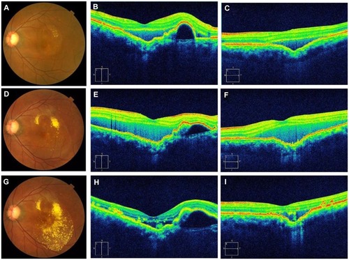 Figure 2 (A–C) are fundus photographs and OCT images before anti-VEGF treatment. (D–F) are fundus photographs and OCT images after initial anti-VEGF treatment. (G–I) are fundus photographs and OCT images after three rounds of anti-VEGF treatment. (B, E and H) are vertical OCT images and (C, F and I) are horizontal OCT images. The left eye shows serous retinal detachment and exudates (A). A choroidal excavation is located just inside the macular area. As described in Figure 1, the OCT images show the separation of the retina between the IS/OS line and the RPE (B). The horizontal image shows choroidal excavation more clearly than the vertical image (C). The left eye shows more exudates than that of her initial visit to us (A) (D) and an increase in serous retinal detachment (E and F). The retinal exudates increased after the 3 injections (G), but serous retinal detachment decreased (H and I).