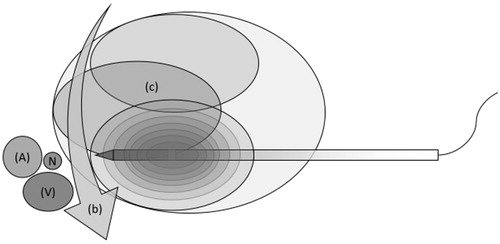 Figure 2. Multiple ablations (b) creating overlapping ablation zones (c). The ablation zone is more spherical as the heat rises more homogeneously between the two electrodes. A, carotid artery; V, jugular vein; N, vagus nerve.