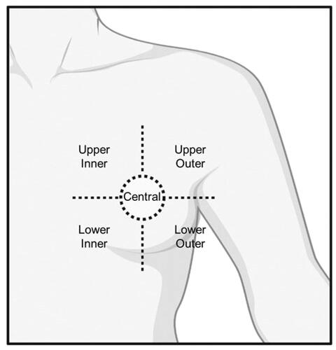 Figure 3. Graphic representation of the tumor position classifications. Five distinct tumor positions are assumed: upper outer; upper inner; lower outer; lower inner; and central tumor position.