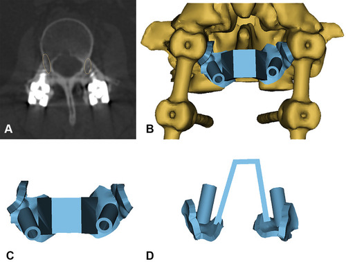 Figure 1 Preoperative plan and 3D model of the navigation template. (A) The yellow ellipses indicate the CBT screw trajectory planned before the surgery. (B) The navigation template with the segment with the original pedicle screw reconstructed by Mimics. (C and D) The top and back view of the navigation template.