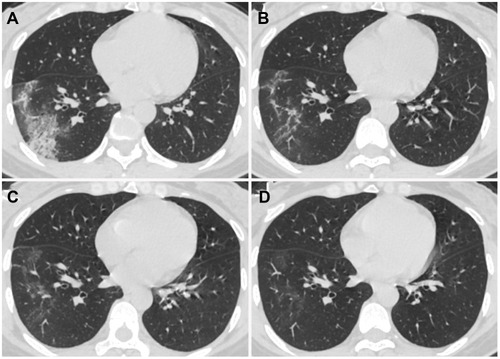 Figure 4 Chest CT images of a 38-year-old non-pregnant female with COVID-19 pneumonia, presenting cough for 1 day. (A) Day 1 after symptom onset, ground-glass opacity (GGO) with consolidation, intralobular and interlobular septal thickening, and air bronchogram in the peripheral region of the right lower lobe were detected. (B) Day 7, the extent and density of the lesions decreased, showing GGO and irregular linear opacities. (C) Day 14, the lesions were dissipated into GGO. (D) Day 20, further resolution of the lesions.