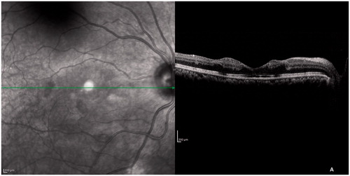 Figure 4. SD-OCT after 6 weeks. The ELM, IS-OS junction, and COST line started regaining their normal architecture but the inner retinal layers looked the same.