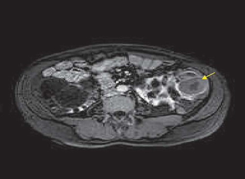 Figure 1.  Postgadolinium T1-weighted image shows slightly hyperintense cyst (arrow) with peripheral contrast enhancement.