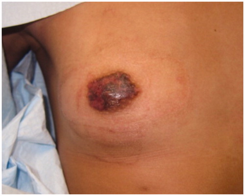 Figure 3. Two months following surgical debridement. Residual angiofibroma at the perimeter of the NAC underwent CO2 laser ablation.