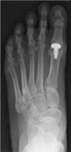 Figure 2 Postoperative anteroposterior views of metatarsals of a patient in the metatarsal-resurfacing group.