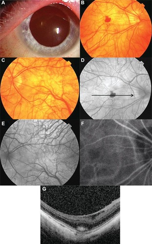 Figure 1 Findings in a 48-year-old Japanese man with oculocutaneous albinism. His best-corrected visual acuity was 2/100 with −14.0 diopters in the right eye.
