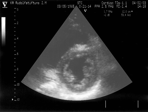 Figure 3.  Echocardiographic parasternal short-axis view of a patient with MELAS syndrome shows extensive hypertrabeculation of the lateral and posterior wall