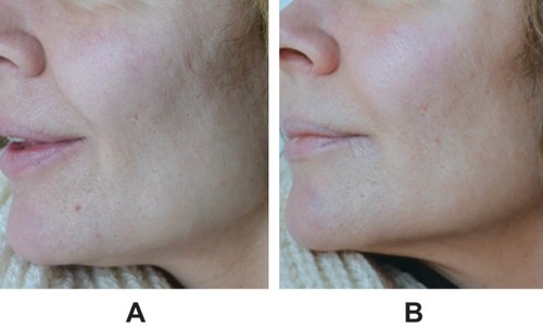 Figure 1 Representative images of facial area (A) before treatment and (B) 1 month after injection of VYC-12L into cheek, jawline, and perioral area, 1.0 mL per side. Images courtesy of Jesper Thulesen, MD.