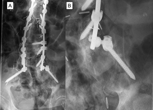 Figure 4 (A) PA x-ray in patient who underwent lumbosacral deformity surgery showing radiolucency in the right iliac screw. (B) Enlarged view of the right iliac screw lucency. This patient developed sacroiliac joint (SIJ) pain that was improved with SIJ injections.