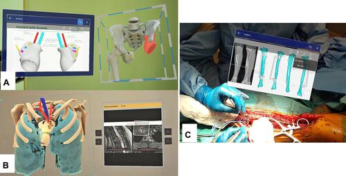 Figure 7 Shows that the MR technology provides instant and on-demand critical medical information at the clinical point of care inside or outside the operating rooms for surgical planning and intraoperative reference. (A) Implant information like screw dimensions for implant fixation in a patient with a pelvic giant cell tumor undergoing tumor resection and 3D-printed custom pelvic prosthetic reconstruction. (B) The representative MRI images in a patient with a solitary T2 bone metastasis undergoing combined anterior and posterior spinal tumor resection and instrumented fixation. (C) The surgical resection planning in PDF file format in a patient with a low-grade bone sarcoma of the left tibia undergoing intercalary tumor resection under the assistance of a 3D-printed resection guide and reconstruction with a vascularized fibular graft transfer.