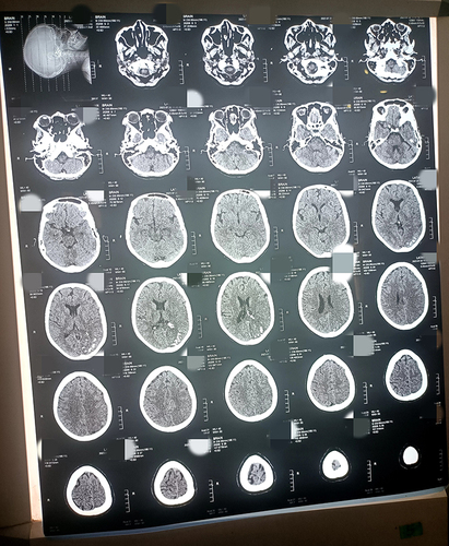 Figure 3 CT brain scan showing cortical calcifications in the left parietal area, 3rd and 4th rows.