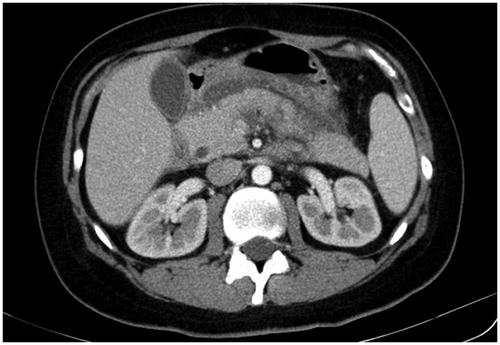 Figure 2c. Multi-slice CT scan of abdomen: the hypoechogenic, enlarged pancreas, particularly its head.