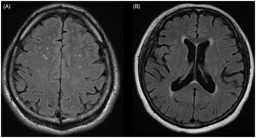 Figure 1. Representative figure of deep white matter lesion (A) and periventricular white matter lesion (B) on a fluid-attenuated inversion recovery (FLAIR) magnetic resonance imaging.