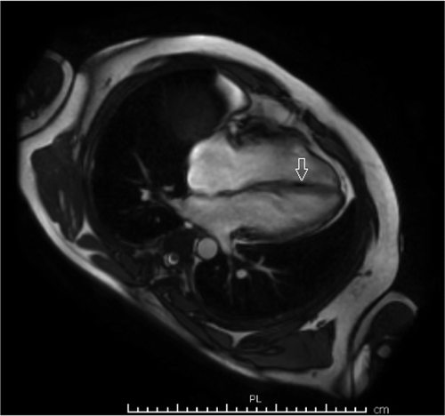 Figure 4. Cardiac MRI showing foci of fat in right ventricular side of interventricular septum (see white arrow).
