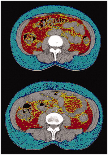 Figure 1. Example of axial computed tomography (CT) at the fourth lumbar vertebrae used for Subcutaneous Adipose Tissue (SAT) and Visceral Adipose Tissue (VAT) density (attenuation) measurements. Abdominal adipose tissue is identified using threshold density cutoffs. For this figure, the cut off values used for SAT were -50 to -150 HU, with -99 to -150 HU shown in dark blue and -50 to -99 HU shown in light blue. The cut off values for VAT were -50 to -150 HU, with -97 to -150 HU shown in yellow and -50 to -97 HU shown in red. Cut off values vary slightly between studies but methodology remains similar. A HU value less negative (closer to zero), indicates that the tissue is more radio dense. Adipose tissue is generally manually highlighted, and mean density can be automatically computed.