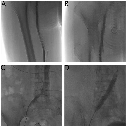 Figure 3 Radiographic image after thrombolysis. (A and B) The blood flow of iliac vein and femoral vein was significantly improved. (C) Stenosis of the iliac vein entering the vena cava. (D) Balloon dilation of iliac vein.