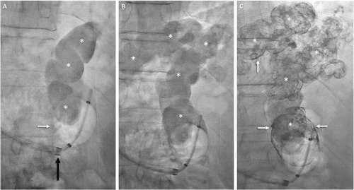 Figure 4 Balloon-assisted retrograde transvenous obliteration of lienorenal shunt.