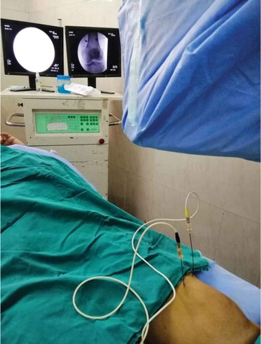 Figure 5. Genicular nerve radiofrequency guided with fluoroscopic images.