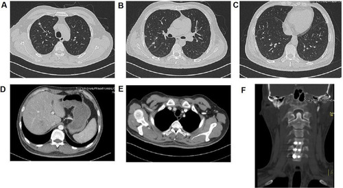 Figure 4 CT and MRI figures before second discharge. Focuses were significantly improved after treatment. (A) CT of the superior field of the lung; (B) CT of the middle field of the lung; (C) CT of the inferior field of the lung; (D) CT of the right-posterior lobe of the liver; (E) CT of the right anterior superior chest wall; (F) MRI of the 5th cervical vertebra.