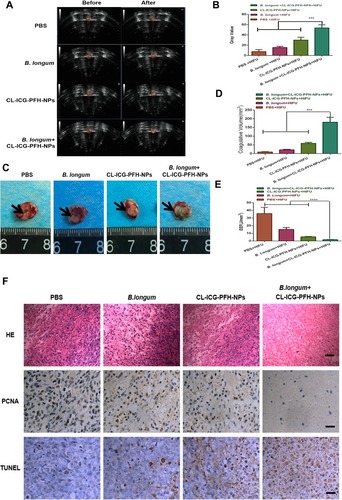 Figure 8 In vivo synergistic HIFU ablation surgery. (A) In vivo US imaging of tumor tissues (red circle) before HIFU ablation and after HIFU ablation in different group. The red dotted circle marks the tumor nodules. (B) The comparison of gray values of tumor tissues in each group after HIFU irradiation. The mean grayscale difference in the B. longum+CL-ICG-PFH-NPs+HIFU group was significantly higher than the other groups (n=5, ***P<0.001). (C) Coagulative necrosis of tumors by TTC staining after HIFU therapy, the necrotic tissue appears gray and the normal tumor tissue is red. (D) The comparison of coagulative necrosis of tumor tissues in each group after HIFU irradiation. The coagulative necrosis volume of the B. longum+CL-ICG-PFH-NPs+HIFU group was significantly bigger than any other groups (n=5, ***P<0.001). (E) The comparison of EEF of tumor tissues in each group after HIFU irradiation. The results showed that the B. longum+CL-ICG-PFH-NPs+HIFU group was significantly different from the other groups (n=5, ****P<0.0001). (F) Optical microscope images of tumor sections from each group after HIFU ablation were stained for HE staining, PCNA and TUNEL assay. There exists a significant boundary between the nonablated and ablated region in HE staining.(200 × magnification), the scale bar is 20 µm. PCNA positive cells are represented in brown and reduced in the coagulation necrosis region after HIFU ablation, TUNEL positive cells are in brown and increased in the coagulation necrosis region (400 × magnification), the scale bar is 10 µm.Abbreviations: ICG, indocyanine green; PFH, perfluorohexanes; HIFU, high-intensity focused ultrasound; HE, hematoxylin and eosin staining; PCNA, proliferating cell nuclear antigen; TUNEL, apoptosis expression; EEF, energy efficiency factor.