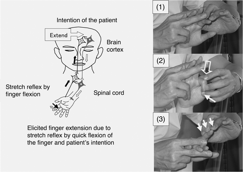 Figure 1. Hypothesized mechanism of action of a novel facilitation method for hemiplegic upper limb and fingers. (Left) The patient can realize his/her intended movements when neurons related to the intended movements are activated by the stretch reflex and neuronal excitation of the patient's intention comes from the prefrontal/premotor cortex. (Right) To facilitate extension of the isolated finger, it was quickly flexed by the therapist (1), the MP joint was flexed by the therapist after saying the instruction ‘Extend’ (2) and slight resistance against finger extension was applied during extension of the finger (3). The open arrow and closed arrow indicate manipulation of the stretch reflex and light touch (resistance) to maintain the α–γ linkage, respectively.