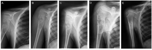 Figure 2. A 9-year-old boy originally presented with right proximal humerus UBC with the symptoms of pain and pathological fracture. (a) Before treatment, an expansile lucent lesion was found in the proximal humerus in the frontal radiograph, with cortical thinning and interruption. (b) On the second day after the surgical procedure, scattered high-density shadows can be observed surrounding the lesion, indicative of the synthetic bone substitute utilized during the treatment. (c, b, and d): the radiographs were taken at 3-, 9- and 12-months postoperatively, respectively. Follow-up radiographs showed a gradual reduction in fracture lines and an increase in callus formation, indicating ongoing bone remodeling and consolidation, consistent with healing changes. The radiograph at 12 months (e) demonstrated near-complete remineralization of UBC and fracture healing and the cortical bone was thickened and remodeled.