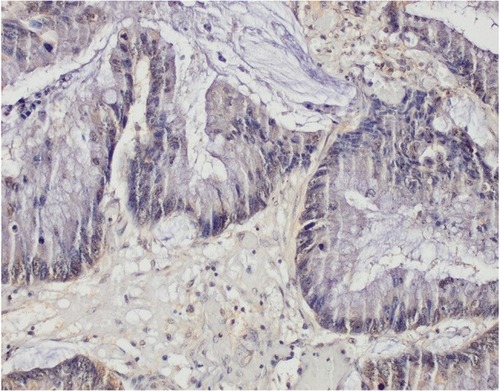 Figure 4 Bladder adenocarcinoma (mucinous) (TMA T124, position B4) (48-year-old male, grade I, stage 2, T2N0M0, malignant bladder cancer) probed anti-TM, counterstained with hematoxylin (magnification 200x).