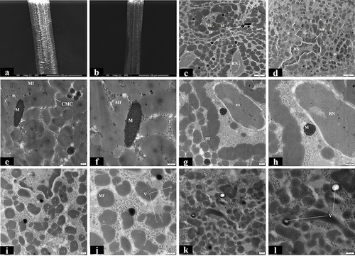 Figure 2 EM images of VAL and healthy black hair. SEM images of black hair (a) and thinner leukotrichia (b) with invisible hair cuticles. TEM images of black hair (c) and leukotrichia (d). TEM examination at high magnification of healthy black hair showed longitudinal section of intact melanosomes (e), macrofibrils (f), remnant nucleus (g) and transverse section of melanosome (h). TEM examination at high magnification of leukotrichia showed smaller melanosome (i), thinner macrofibrils (j) and vesicles in (k) and (l).