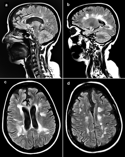 Figure 1. Sagittal and axial fluid-attenuated inversion recovery (FLAIR) MRI sequences showing multiple new plaques in periventricular, juxtacortical, and cortical areas.