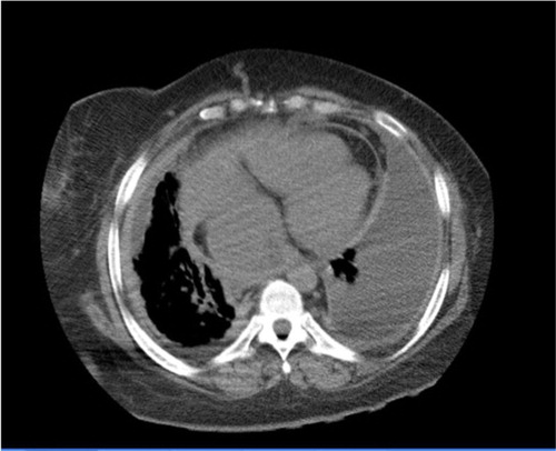 Fig. 4 Chest CT (mediastinal window) at lower lung field showing b/l lower lung pleural effusion, more on the left, bilateral pleural thickening, and cardiomegaly.