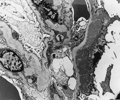 Figure 2. Electron micrography of a glomerulus revealing subepithelial electron dense deposits (×4000).