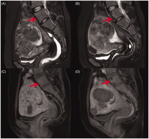 Figure 1. Sagittal view of MR images obtained from a 41-year-old patient with uterine fibroids before and 1 day after HIFU treatment. (A) Pre-HIFU T2WI image showed normal signal intensity in lumbar vertebrae (arrow); (B) Post-HIFU T2WI image showed a sheet-like hypointense area in the vertebrae of lumbar 5 (arrow); (C) Pre-HIFU contrast-enhanced image showed normal enhancement in the vertebrae of lumbar 5 (arrow); (D) Post-HIFU contrast-enhanced image showed a partial perfusion area corresponds to the hypointense area in the vertebrae of lumbar 5 on post-HIFU T2WI (arrow).
