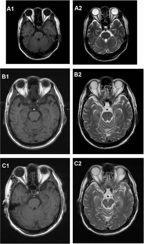 Figure 2 (A1 and A2) The baseline MRI scan of the patient’s head in August 2020. (B1 and B2) MRI scan of the head after the first seizure in October 2020. (C1 and C2) MRI scan of the head after the second seizure.