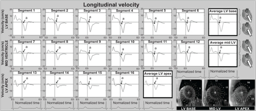 Figure 3 Longitudinal velocity graphs for individual left ventricular segments (American Heart Association segmentation model) showing the influence of reflected aortic pressure waves on longitudinal motion in early diastole. The graphs represent average values for all volunteers. Positive values correspond to downward motion along the ventricular longitudinal axis (ie, toward the apex), while negative values reflect upward displacement (ie, toward the base). Average velocities for basal, mid, and apical slices are shown in bold outline. The arrows (a) show a brief notch in early diastole corresponding to the expected impact with the reflected wave travelling in an opposite direction. The right lower images show left ventricular short axis images of the base, mid ventricle, and apex, divided into 16 segments, which correspond to the individual left ventricular segments.