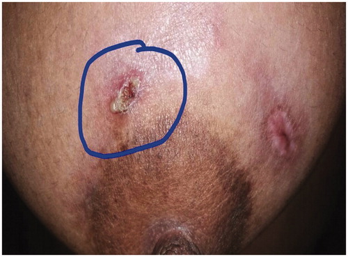 Figure 4. Pus dicharge at 7 months from starting ATT.