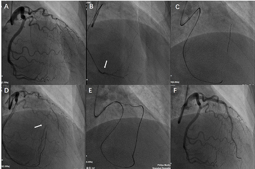 Figure 2 Angiogram of an LAD CTO of a 59-year-old female patient with ischemia symptoms (A). Tip injection via a Corsair microcatheter facilitated the visualization of septal channels (B). (C) The Sion guidewire successfully crossed the septal pathways into the distal LAD segment. Tip injection again contributed to ensuring the distal true course (D). The Gaia 3 guidewire crossed the occlusion via a retrograde approach (E). (F) The final angiogram after stent implantation of the LAD.