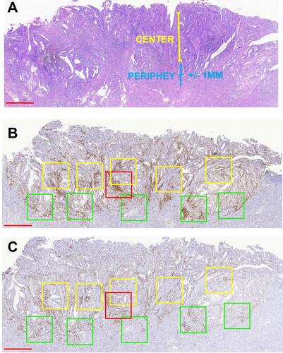 Figure 1 Strategy for quantifying TILs in endometrioid EC. (A) Representative H&E staining of endometrioid EC to define the tumor center and periphery. (B and C) Quantification of CD3+ cells (B) and CD8+ cells (C) in the tumor center and periphery. Red box, hotspot (single 1-mm2 box); green boxes, tumor periphery (five 1-mm2 boxes); yellow boxes, central areas (five 1-mm2 boxes). Scale bars: 1 mm.