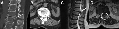 Figure 6 Preoperative CT and MRI images. Preoperative sagittal (A) and axial (B) views by computed tomography. Preoperative sagittal (C) and axial (D) views by magnetic resonance imaging. The calcified lumbar disc compression nerve is indicated by the white arrow and white circle. The patient was a 70-year-old woman with preoperative CT and MRI showing a calcified lumbar disc herniation with nerve compression.The white arrows and circles indicate the location of the calcification foci pressing on the nerve root.
